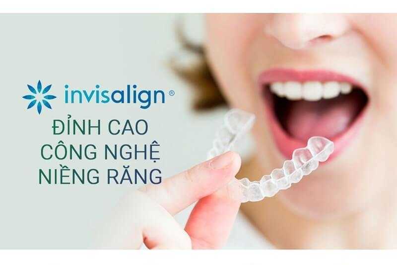 Công nghệ niềng răng trong suốt Invisalign - Nha khoa V-Trust
