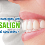 Niềng răng trong suốt Invisalign có cần nhổ răng