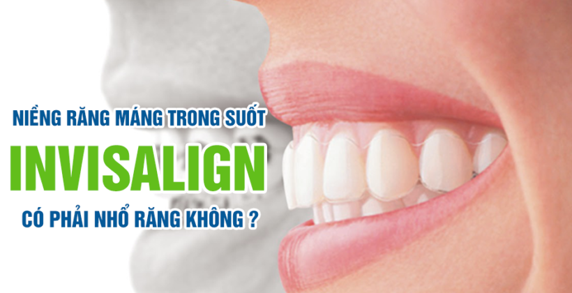 Niềng răng Invisalign có cần phải nhổ răng?