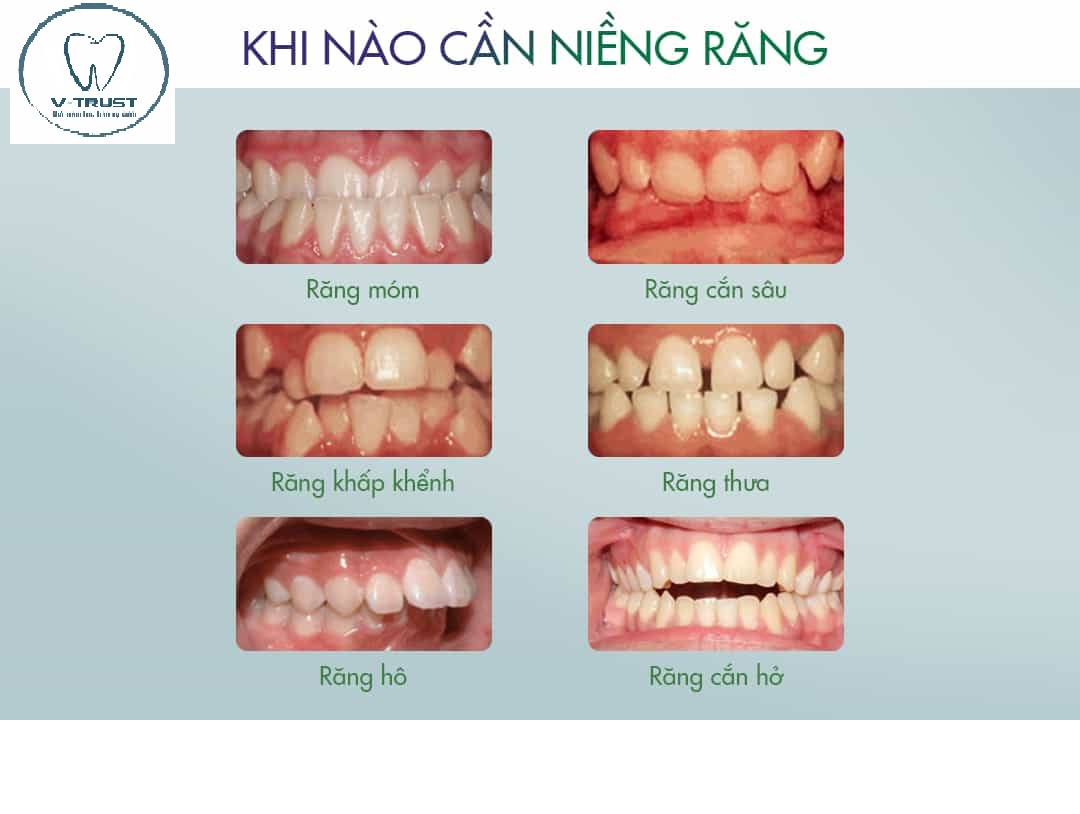 Khi nào cần niềng răng?
